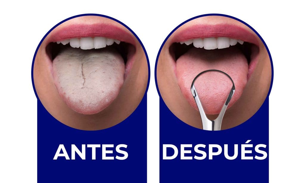 Antes y después de usar un raspador de lengua