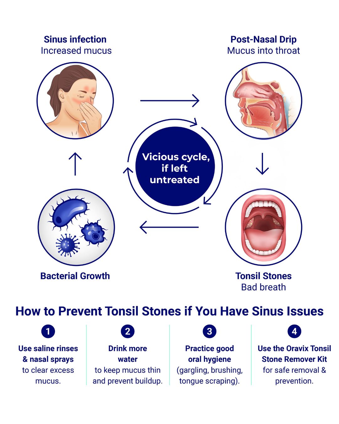 Infographic showing how sinus issues can lead to tonsil stones. The cycle begins with a sinus infection that causes mucus to drip down the throat (post-nasal drip). This mucus carries bacteria, which then gets trapped in the tonsils, hardens, and forms tonsil stones. The center of the image says: "Yes, sinus issues can cause tonsil stones." At the bottom, four prevention tips are listed: Use saline rinses to keep sinuses clear. Stay hydrated to thin mucus. Rinse your tonsils 2–3 times a week to flush out debris. Use a tongue scraper daily to stop bacteria buildup.