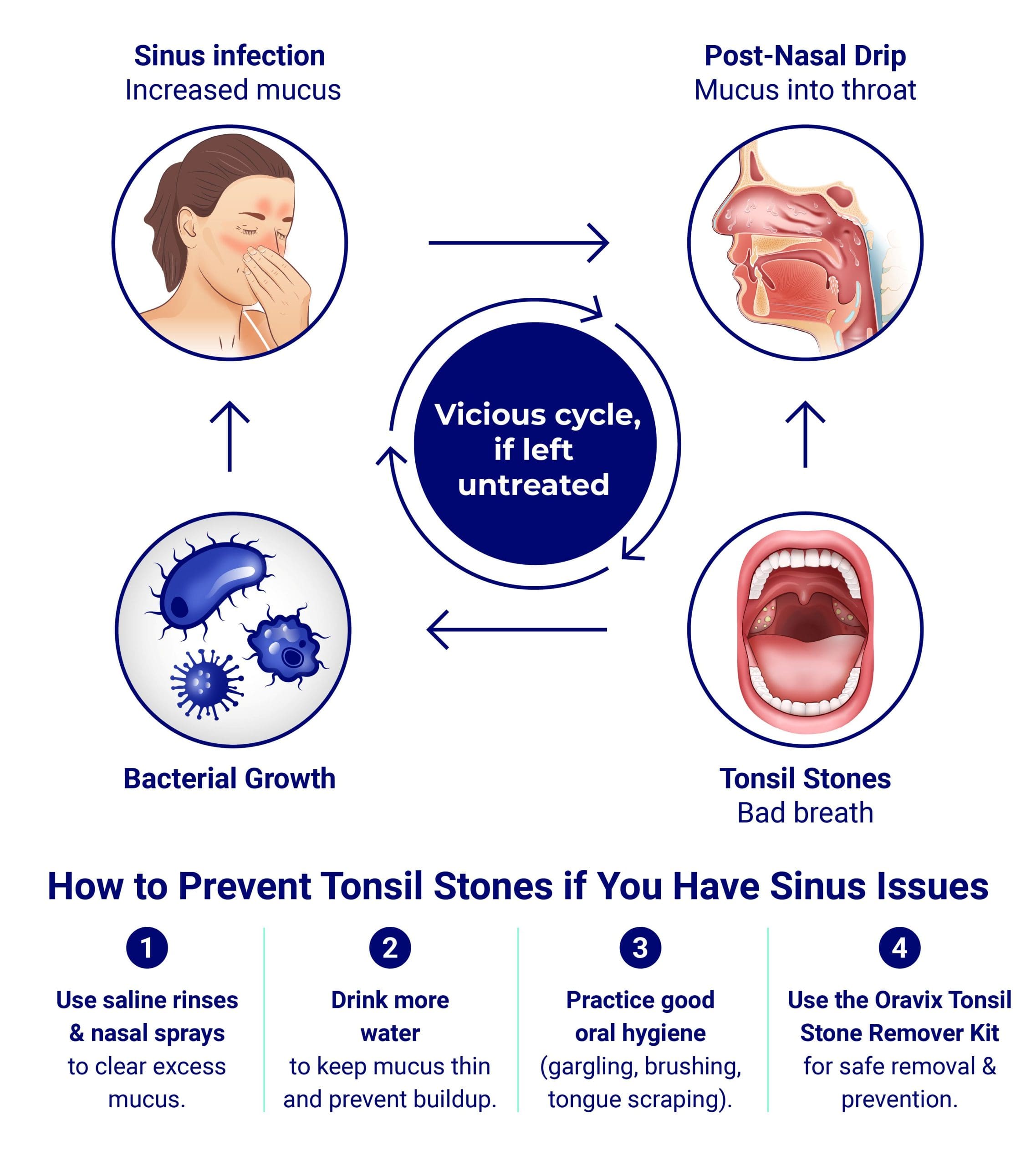 Infographic showing how sinus issues can lead to tonsil stones. The cycle begins with a sinus infection that causes mucus to drip down the throat (post-nasal drip). This mucus carries bacteria, which then gets trapped in the tonsils, hardens, and forms tonsil stones. The center of the image says: "Yes, sinus issues can cause tonsil stones."<br />
At the bottom, four prevention tips are listed:</p>
<p>Use saline rinses to keep sinuses clear.</p>
<p>Stay hydrated to thin mucus.</p>
<p>Rinse your tonsils 2–3 times a week to flush out debris.</p>
<p>Use a tongue scraper daily to stop bacteria buildup.