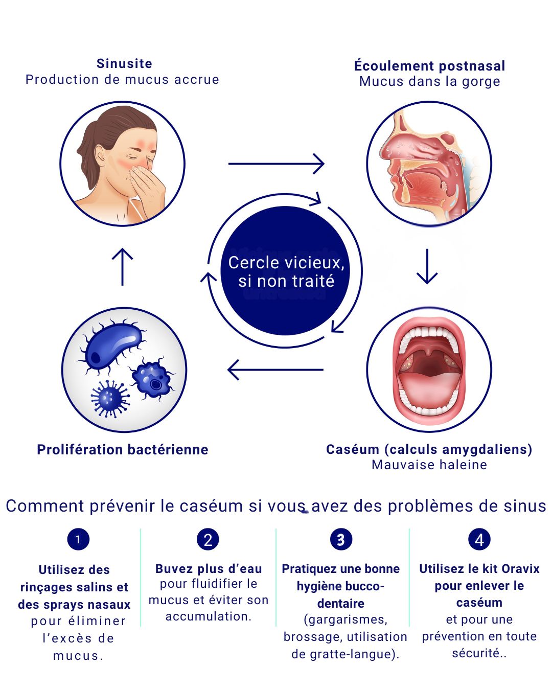 FR Oravix Sinus Tonsil Stone Connection Illustration Schéma montrant le lien entre sinusite et caséum. Une sinusite provoque un excès de mucus, qui s’écoule dans la gorge (écoulement post-nasal), recouvre les amygdales et favorise la formation de caséum (calculs amygdaliens) et de la mauvaise haleine. Le cercle vicieux inclut : infection des sinus → écoulement post-nasal → caséum et mauvaise haleine → prolifération bactérienne → nouvelle sinusite. Le schéma propose aussi des conseils de prévention : utiliser des rinçages salins et sprays nasaux, boire plus d’eau, pratiquer une bonne hygiène buccale (gargarismes, brossage, utilisation de gratte-langue) et utiliser le kit Oravix pour retirer le caséum en toute sécurité.