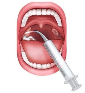 Tonsil Stone Remover Kit Curved Tip Syringe