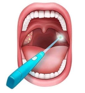 Tonsil Stone Remover Kit Remove