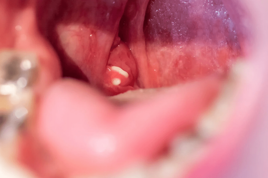 Close-up photo of the inside of a person's mouth showing a visible white tonsil stone lodged in a tonsil crypt near the back of the throat. Surrounding tissue appears slightly red.