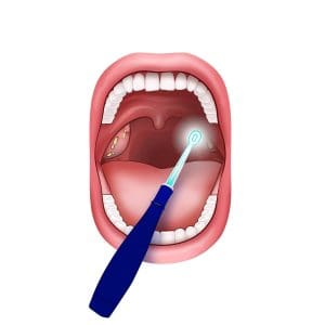 tonsil tone removal scoop in action