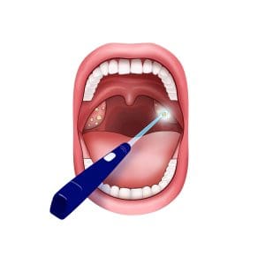tonsil-tone-removal-scoop-in-action-led-oravix